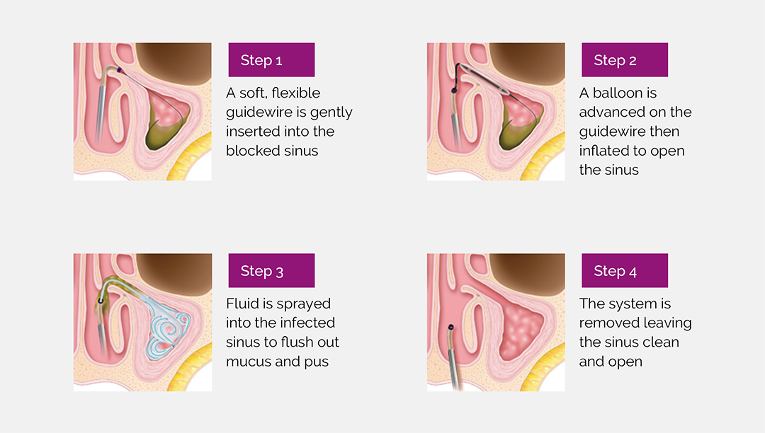 Balloon Sinuplasty Surgeon Philadelphia Sinusitis Relief