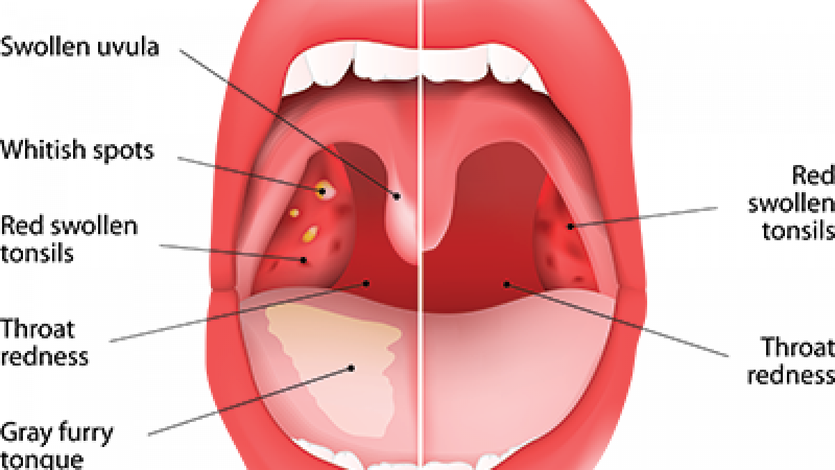 Swollen Tonsils With White Spots And Swollen Glands