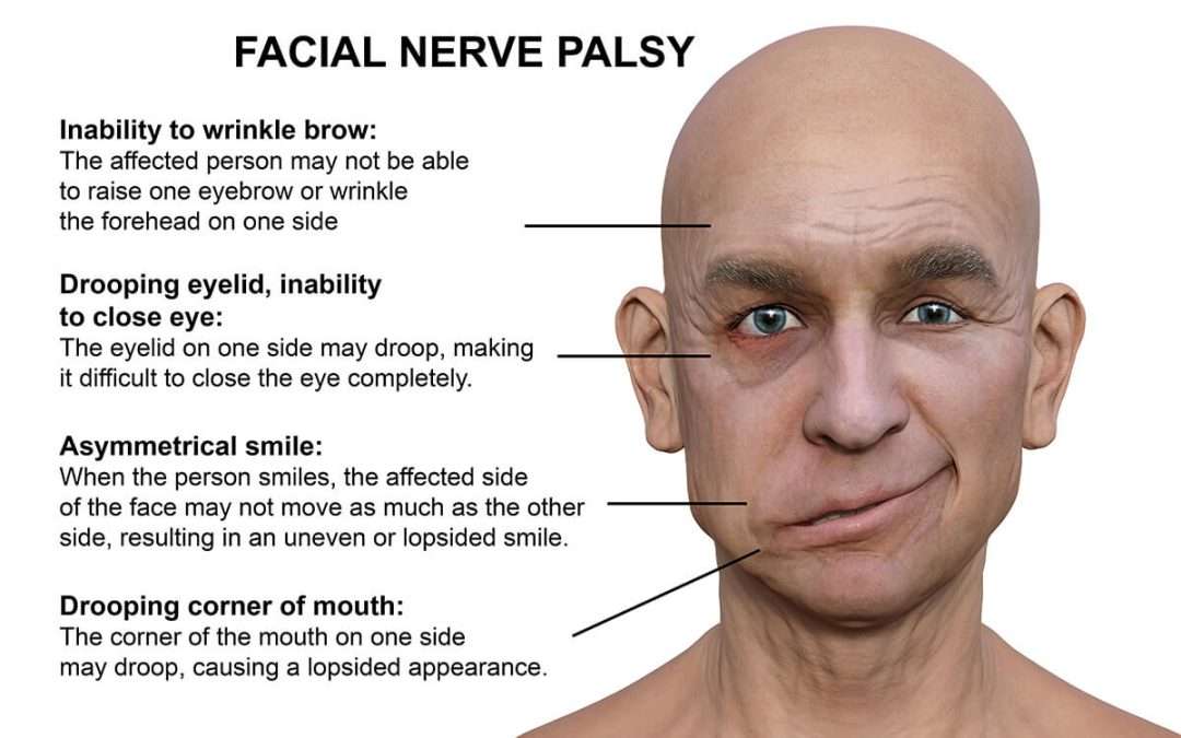 COVID-19 and Bell’s Palsy