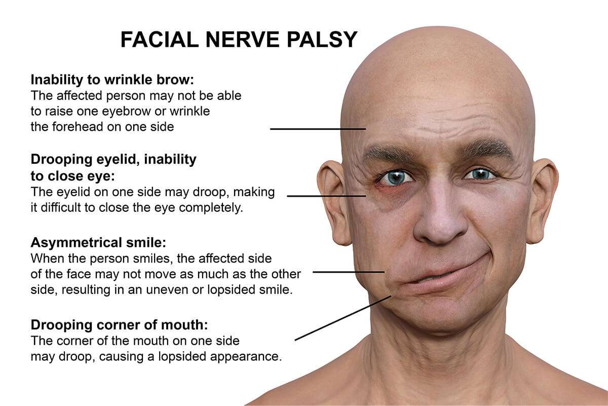 Bell s Palsy Doctor Philadelphia Bell s Palsy