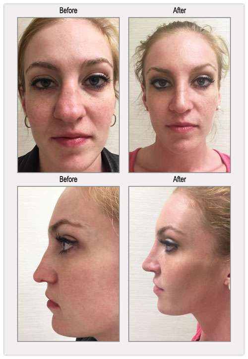 Cosmetic Rhinoplasty Philadelphia Before and After Images - BergerHenry ...