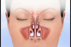 Deviated septum with enlarged turbinates - BergerHenry ENT Specialty Group