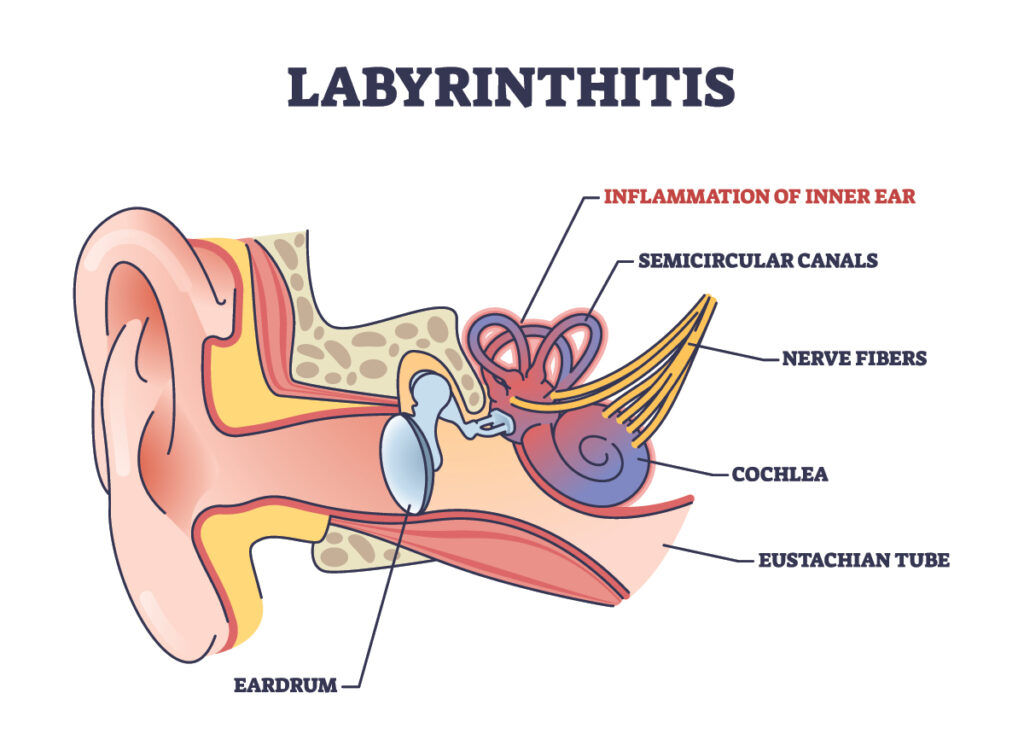 labyrinthitis illustration