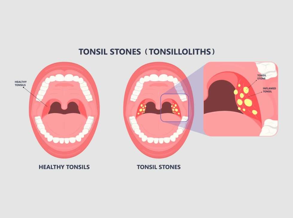 Tonsilloliths Archives - BergerHenry ENT Specialty Group